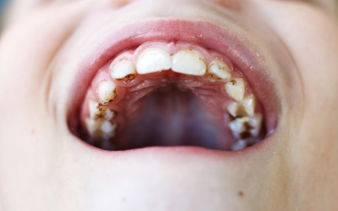 Schwarze Verfärbungen bei Kinderzähnen – was steckt dahinter?